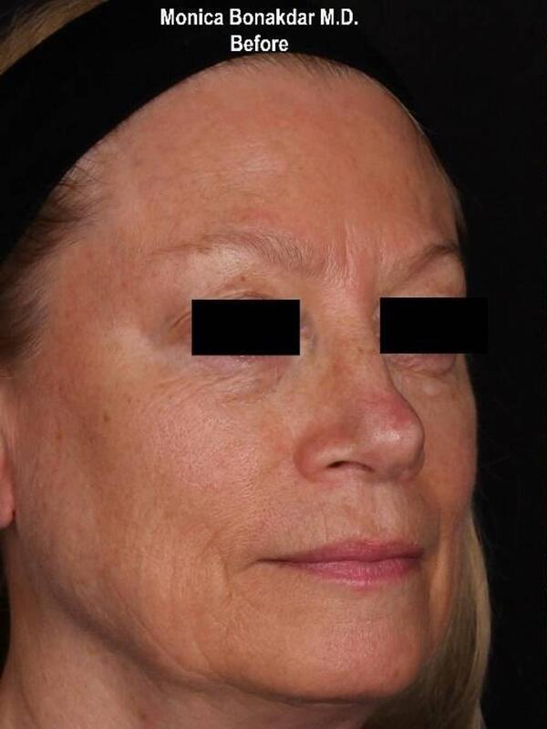 Dermal Fillers before at Bonakdar Aesthetics in Newport Beach, CA