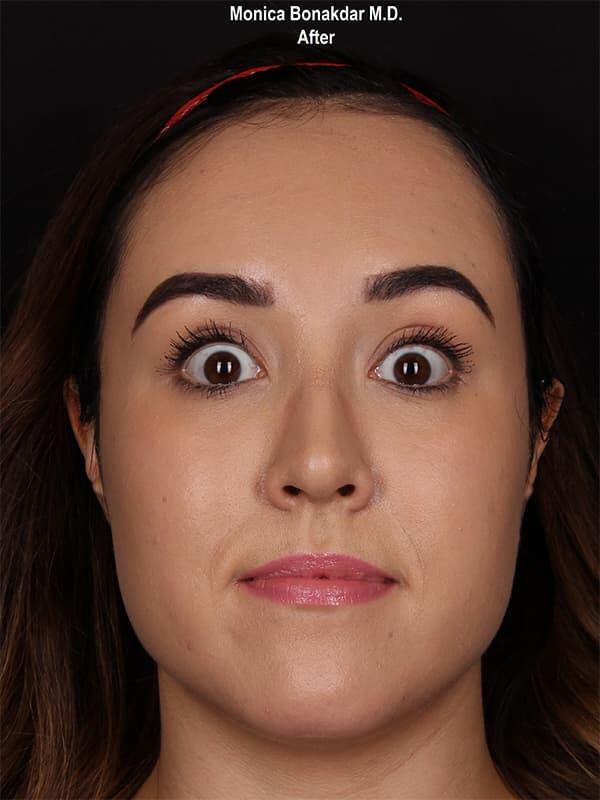 Botox after at Bonakdar Aesthetics in Newport Beach, CA