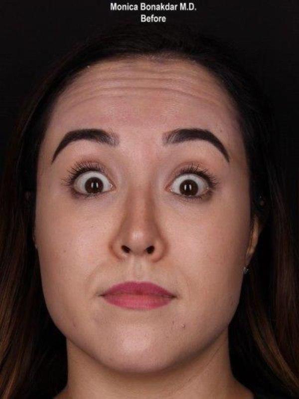 Botox before at Bonakdar Aesthetics in Newport Beach, CA