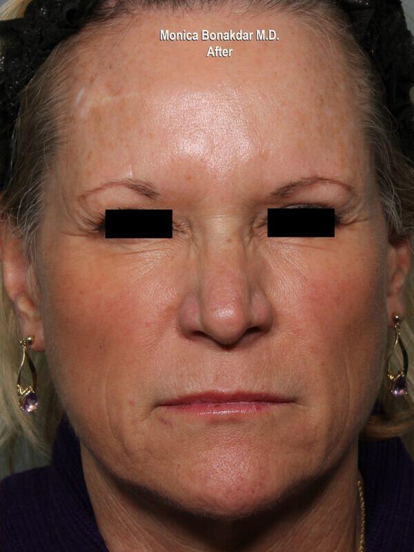 Botox after at Bonakdar Aesthetics in Newport Beach, CA