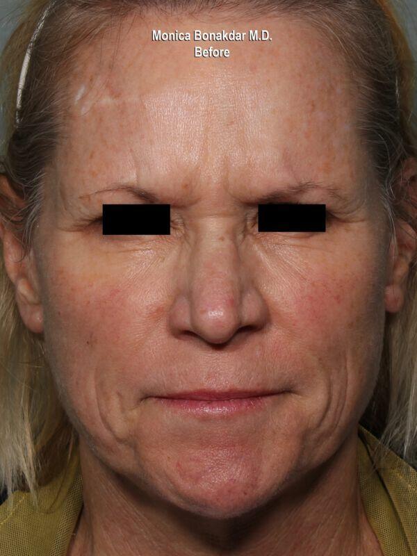 Botox before at Bonakdar Aesthetics in Newport Beach, CA