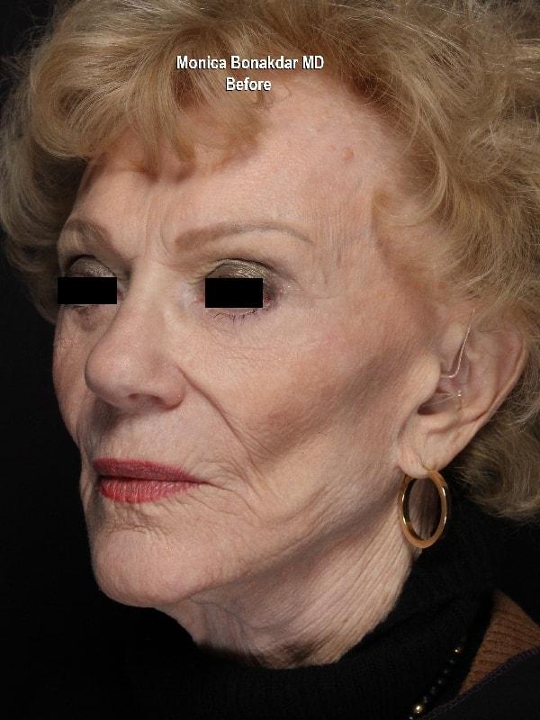 Dermal Fillers before at Bonakdar Aesthetics in Newport Beach, CA