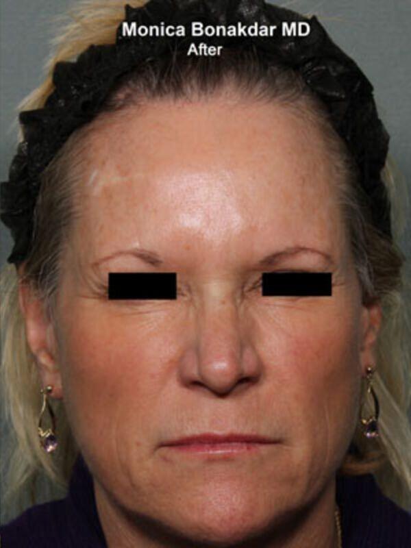 Bonakdar Aesthetics botox after — Newport Beach, CA