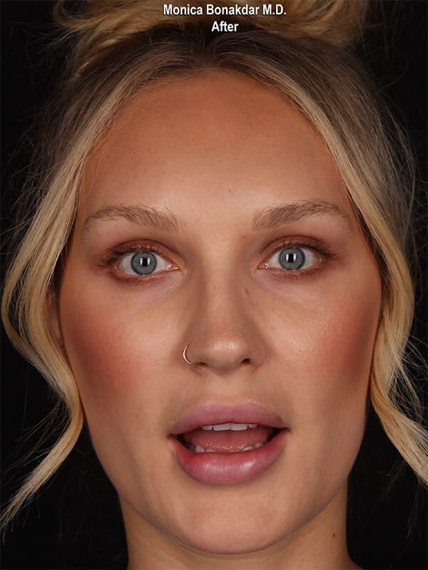 Botox after at Bonakdar Aesthetics in Newport Beach, CA