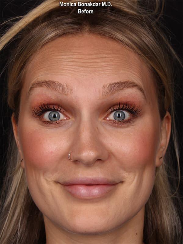 Botox before at Bonakdar Aesthetics in Newport Beach, CA