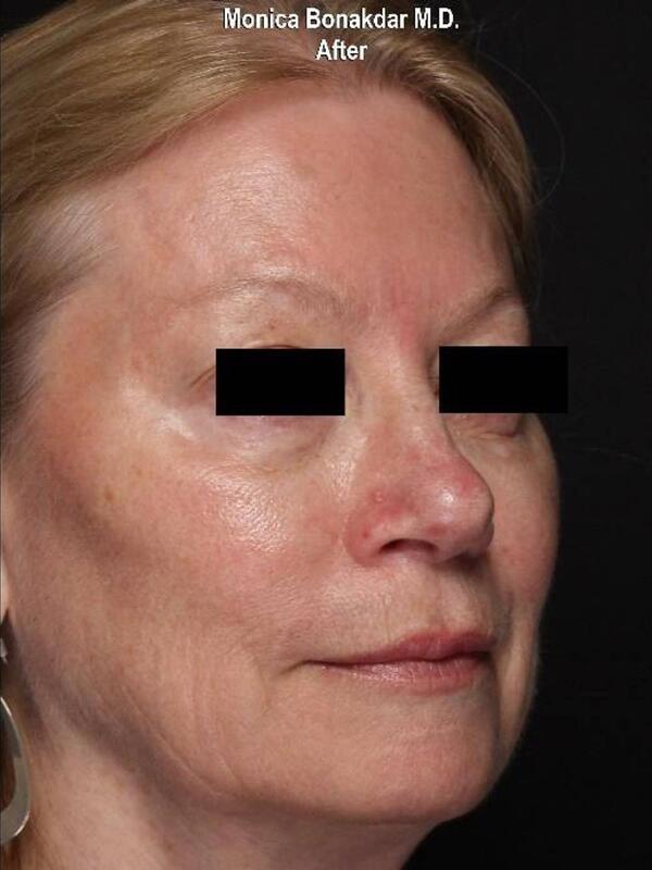 Dermal Fillers after at Bonakdar Aesthetics in Newport Beach, CA