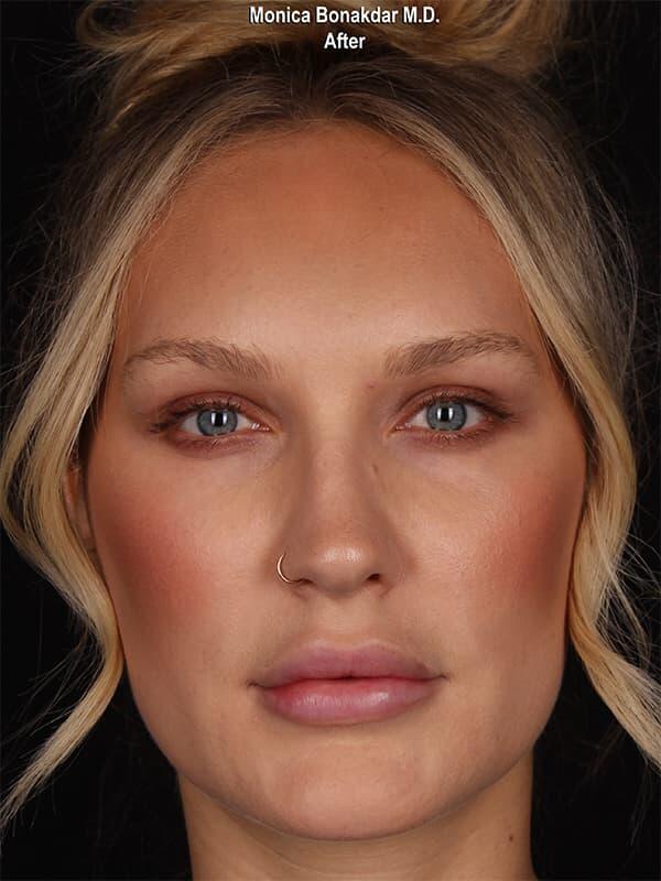 Botox after at Bonakdar Aesthetics in Newport Beach, CA