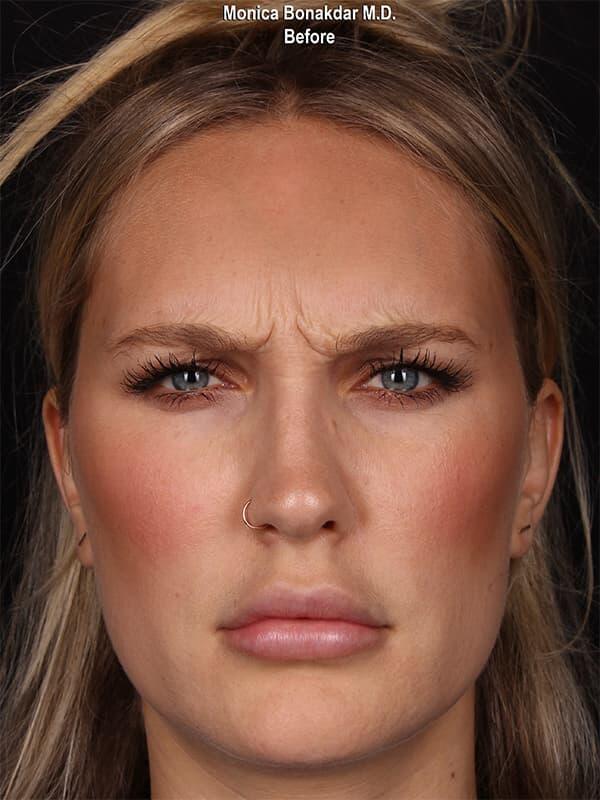 Botox before at Bonakdar Aesthetics in Newport Beach, CA