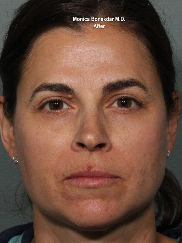 Botox after at Bonakdar Aesthetics in Newport Beach, CA