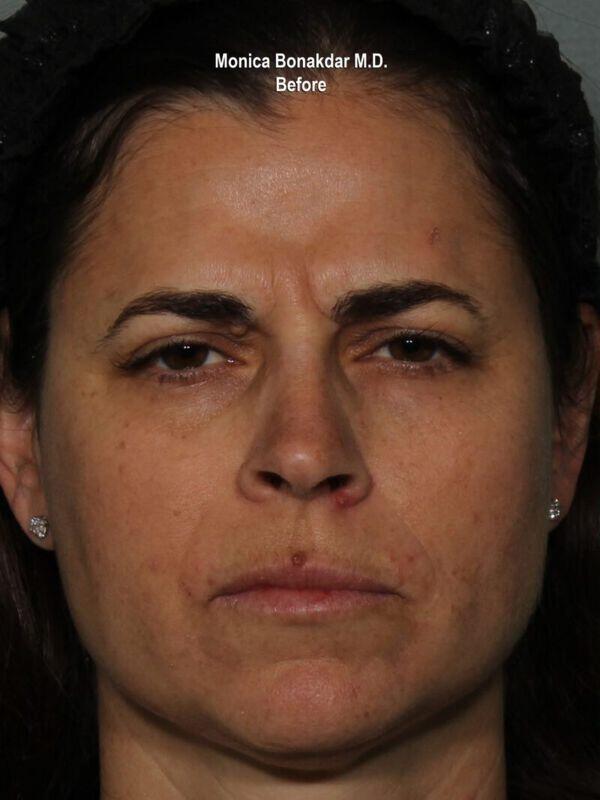 Botox before at Bonakdar Aesthetics in Newport Beach, CA