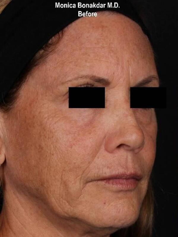 Dermal Fillers before at Bonakdar Aesthetics in Newport Beach, CA