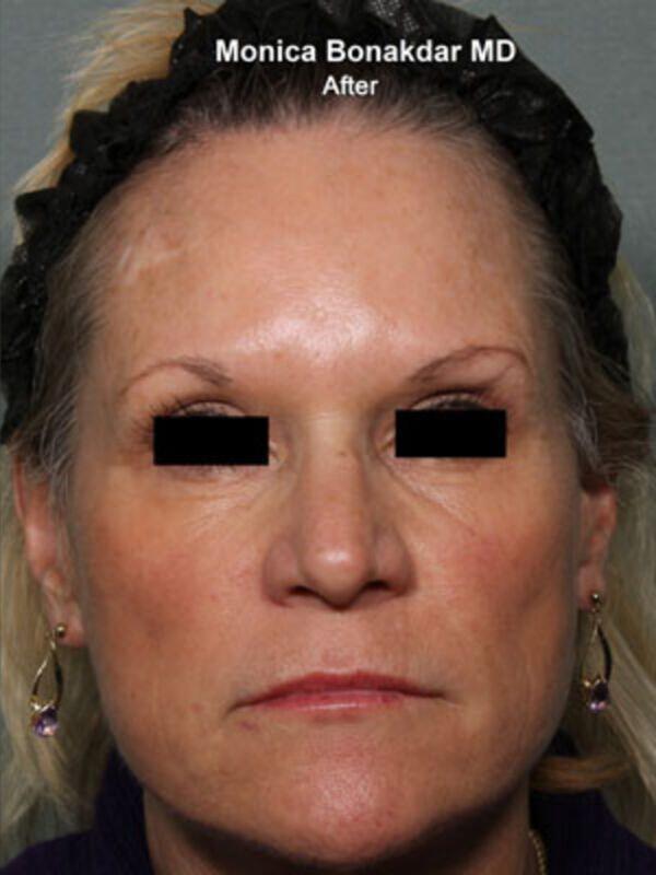Botox after at Bonakdar Aesthetics in Newport Beach, CA
