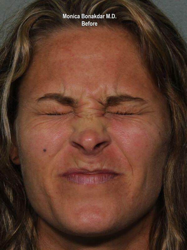 Botox before at Bonakdar Aesthetics in Newport Beach, CA
