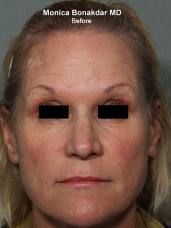 Botox before at Bonakdar Aesthetics in Newport Beach, CA