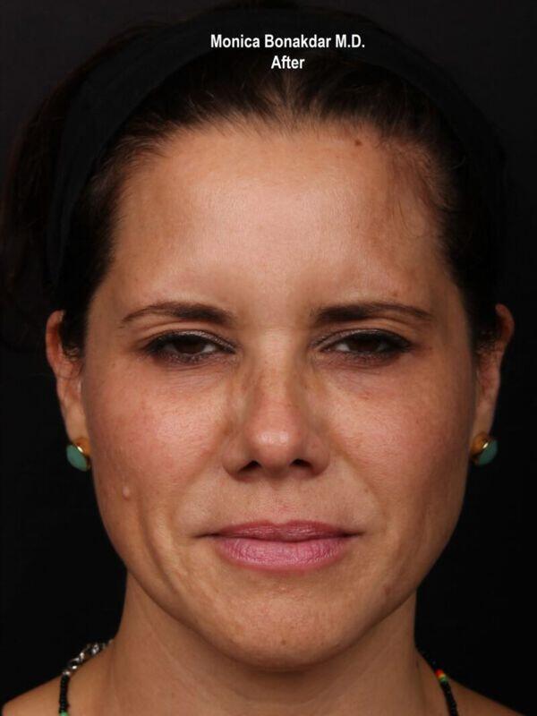Botox after at Bonakdar Aesthetics in Newport Beach, CA