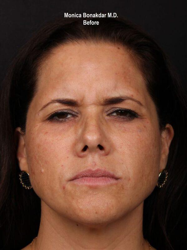 Botox before at Bonakdar Aesthetics in Newport Beach, CA