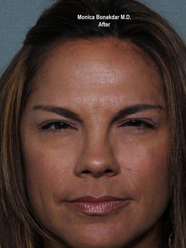 Botox after at Bonakdar Aesthetics in Newport Beach, CA