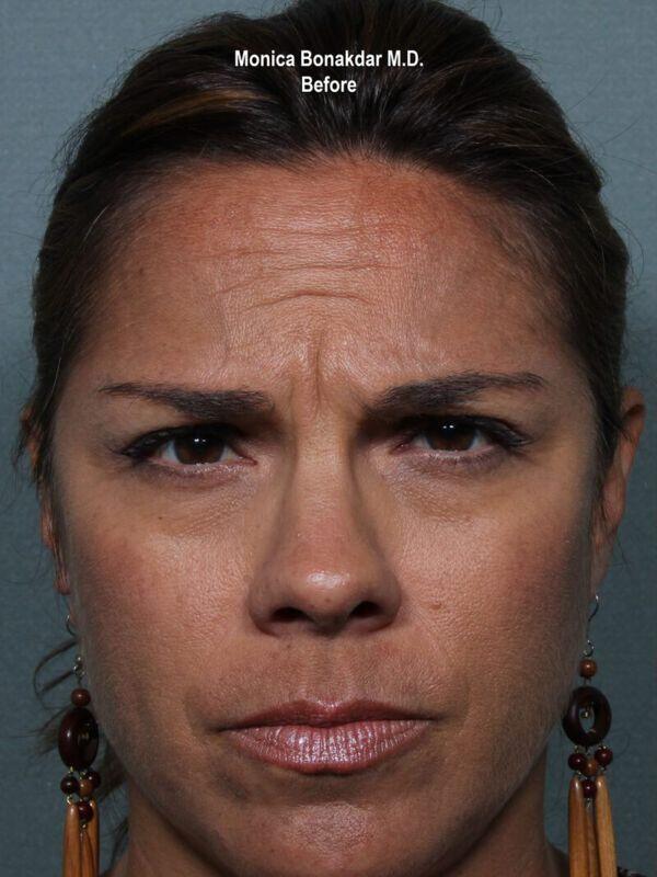 Botox before at Bonakdar Aesthetics in Newport Beach, CA