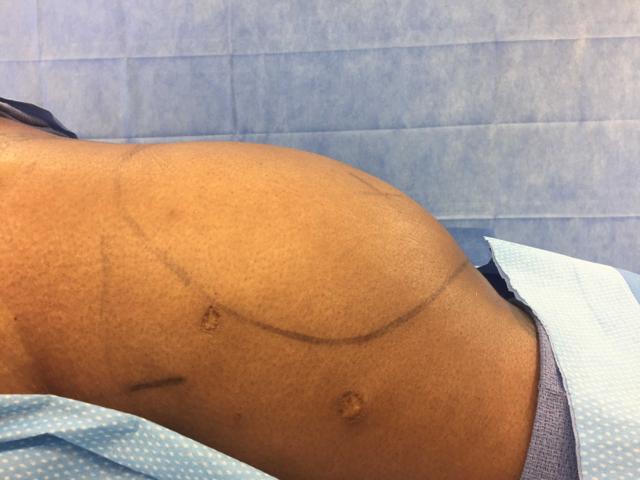 Brazilian Butt Lift before at DeConti Plastic Surgery in Richmond, VA