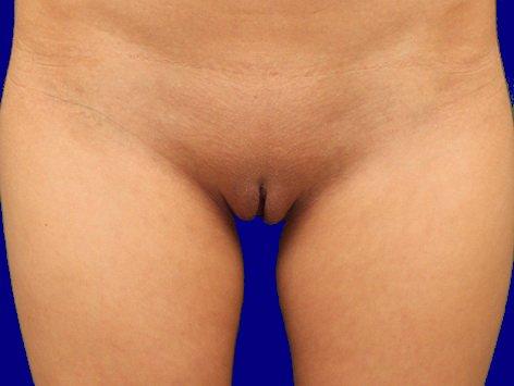 DeConti Plastic Surgery labiaplasty after — Richmond, VA