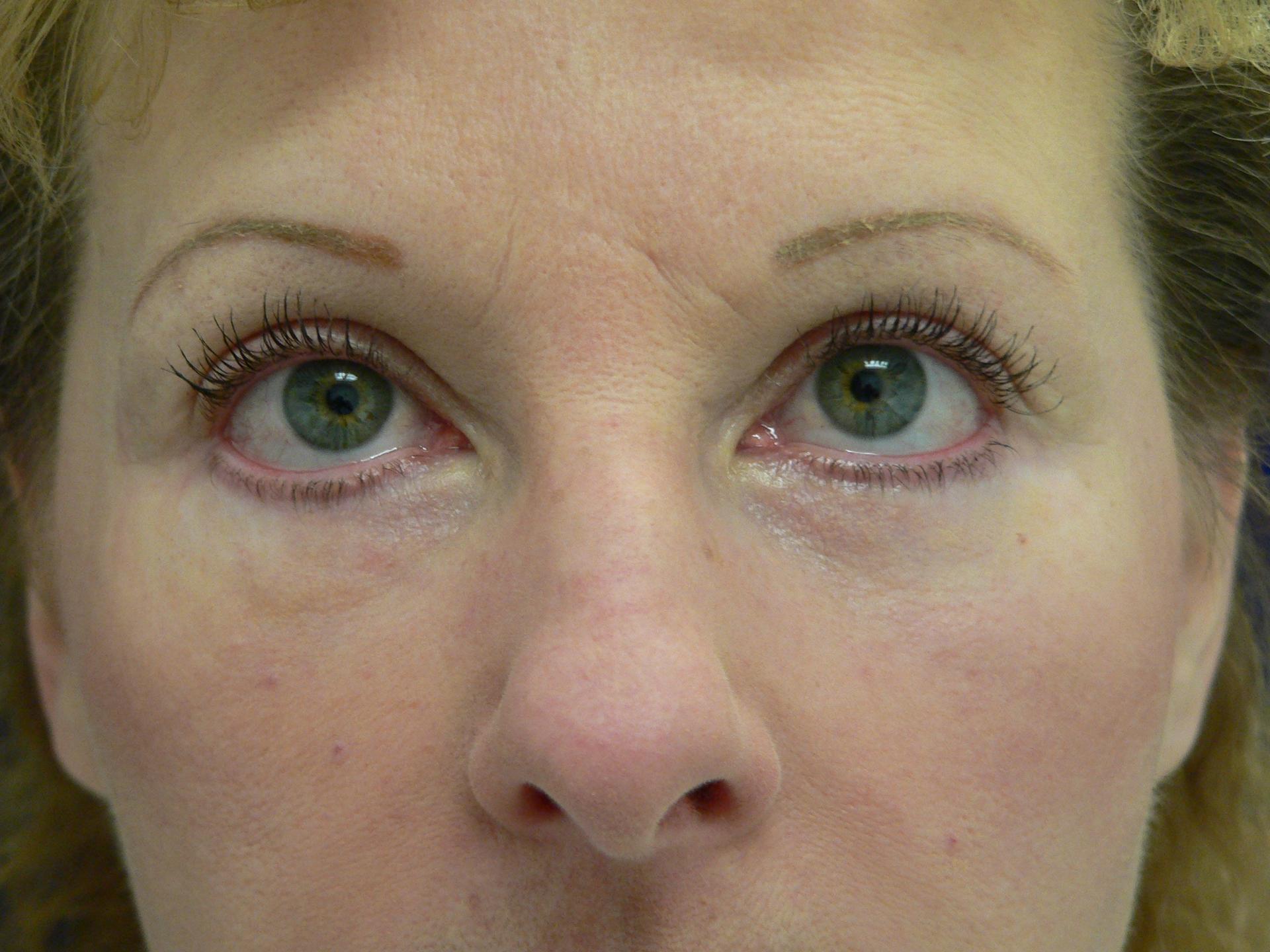 DeConti Plastic Surgery blepharoplasty result — Richmond, VA