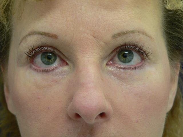 Blepharoplasty result at DeConti Plastic Surgery in Richmond, VA