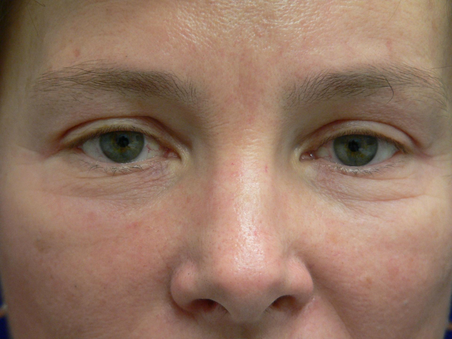 DeConti Plastic Surgery eyelid lift result — Richmond, VA
