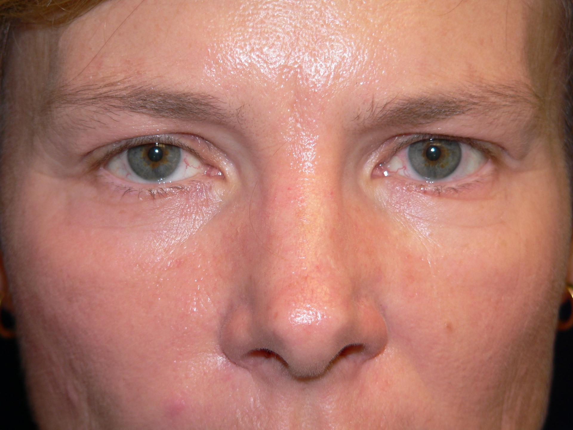 DeConti Plastic Surgery blepharoplasty result — Richmond, VA