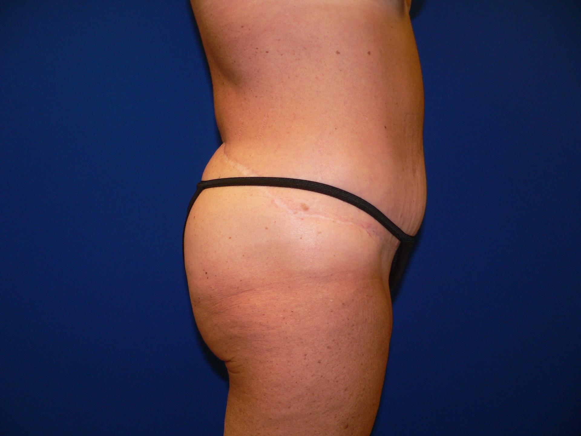 DeConti Plastic Surgery tummy tuck after — Richmond, VA