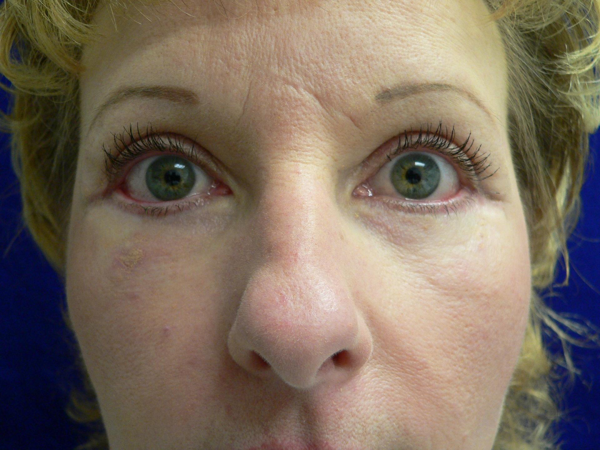 DeConti Plastic Surgery blepharoplasty result — Richmond, VA