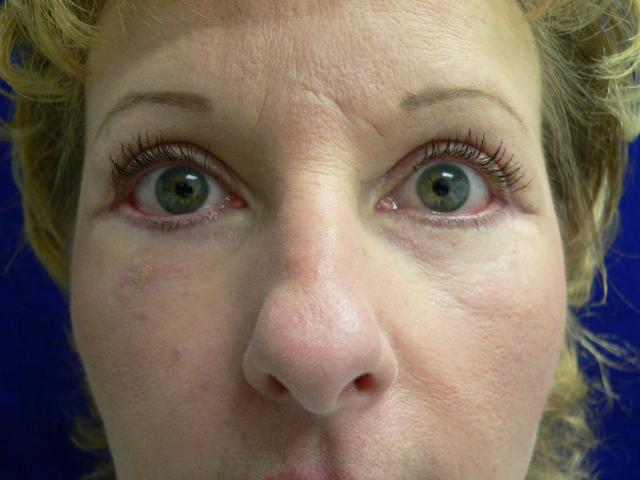 Blepharoplasty result at DeConti Plastic Surgery in Richmond, VA