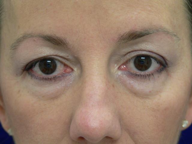 Blepharoplasty result at DeConti Plastic Surgery in Richmond, VA