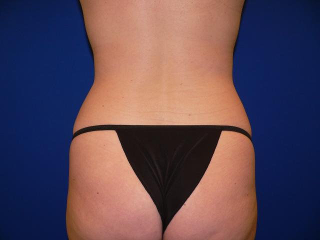 Brazilian Butt Lift before at DeConti Plastic Surgery in Richmond, VA