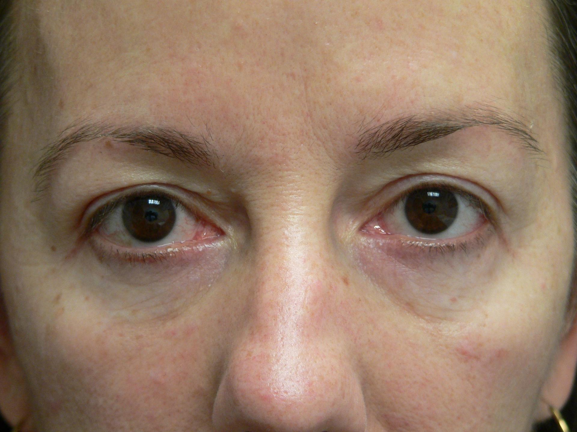 DeConti Plastic Surgery blepharoplasty result — Richmond, VA