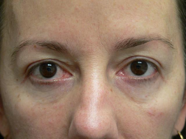 Blepharoplasty result at DeConti Plastic Surgery in Richmond, VA