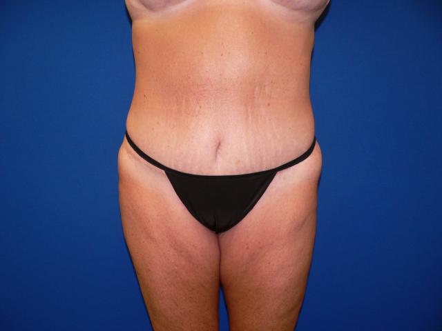 Tummy Tuck after at DeConti Plastic Surgery in Richmond, VA