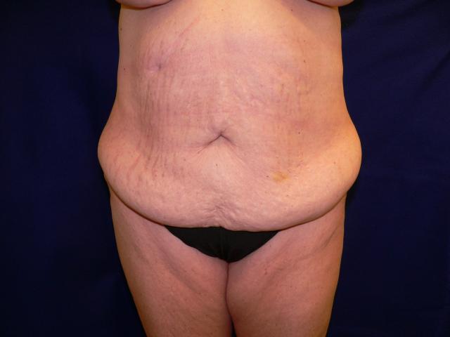 Tummy Tuck before at DeConti Plastic Surgery in Richmond, VA