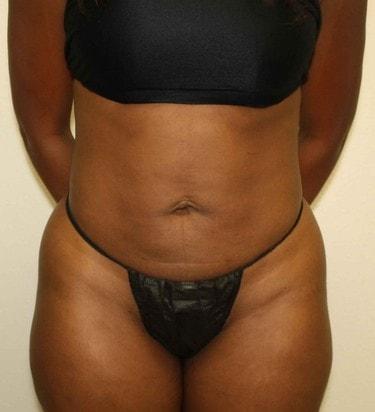 New Tampa Plastic Surgery (G. Peter Fakhre, MD) liposuction after — Wesley Chapel, FL