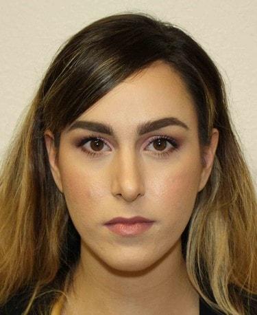 New Tampa Plastic Surgery (G. Peter Fakhre, MD) rhinoplasty after — Wesley Chapel, FL