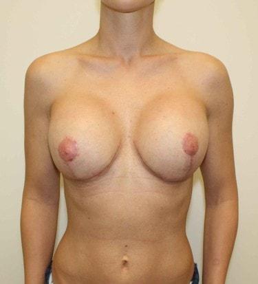 New Tampa Plastic Surgery (G. Peter Fakhre, MD) breast augmentation revision after — Wesley Chapel, FL
