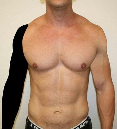 New Tampa Plastic Surgery (G. Peter Fakhre, MD) liposuction after — Wesley Chapel, FL