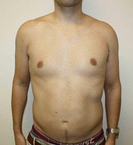 New Tampa Plastic Surgery (G. Peter Fakhre, MD) liposuction after — Wesley Chapel, FL