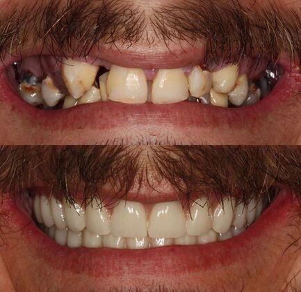 Atlanta West Dentistry veneers result — Lithia Springs, GA