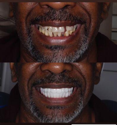 Atlanta West Dentistry veneers result — Lithia Springs, GA