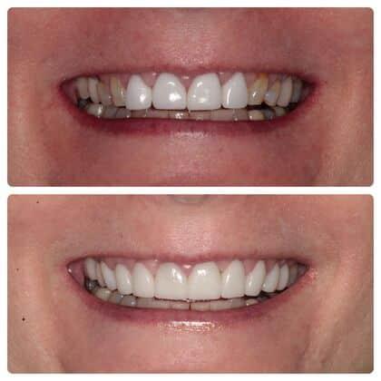 Atlanta West Dentistry veneers result — Lithia Springs, GA