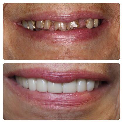 Atlanta West Dentistry veneers result — Lithia Springs, GA