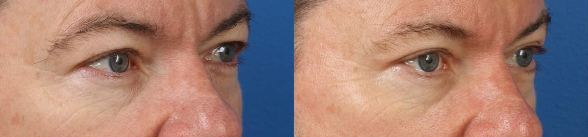 Philip Miller, MD eyelid lift result — New York, NY