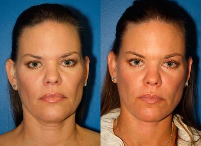 Philip Miller, MD facelift result — New York, NY