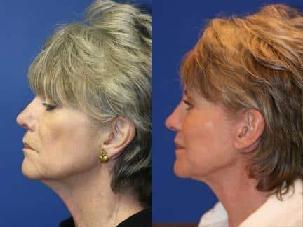 Philip Miller, MD facelift result — New York, NY