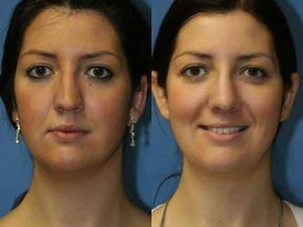 Philip Miller, MD rhinoplasty result — New York, NY